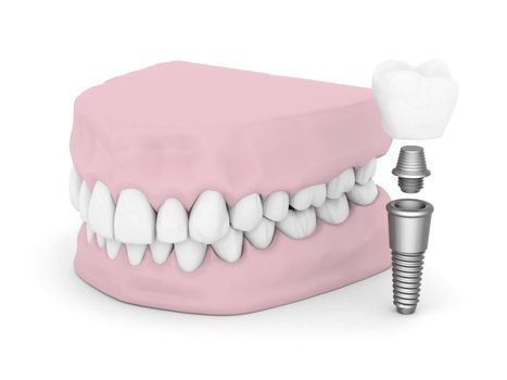 Dental implants isolated on white background