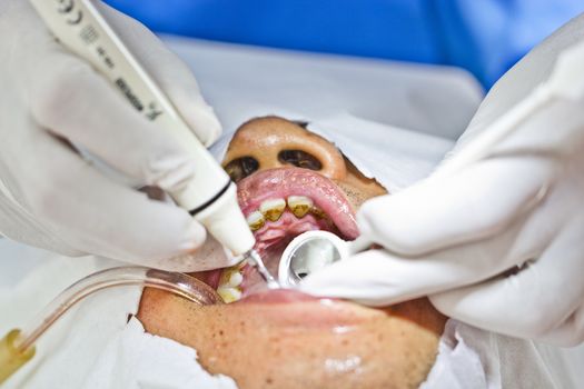 special dental prophylaxis service in rural areas