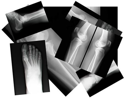 close up of human leg bone X-rays