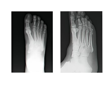 close up of human leg bone X-rays