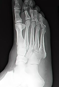 human leg bone X-rays