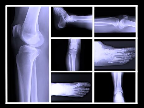 human leg bone X-rays