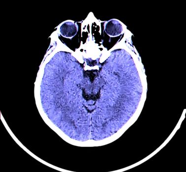 X-ray image of the brain computed tomography