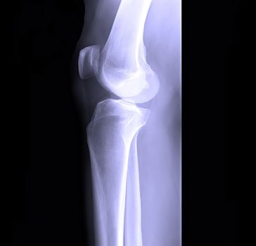 human leg bone X-rays