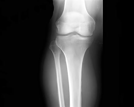 human leg bone X-rays