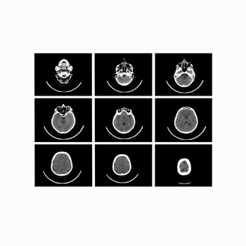 X-ray image of the brain computed tomography