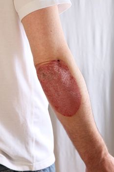 Person suffering from psoriasis with a large inflamed patch of red skin extending from the elbow covered in silvery scales , also known as plaque psoriasis