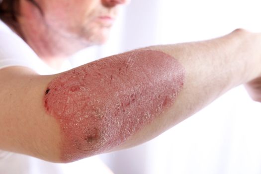 Person with plaque psoriasis of the arm causing an inflamed red patch of skin covered in silvery scales to extend from the elbow, a chronic lifelong disease that is incurable but non-contagious