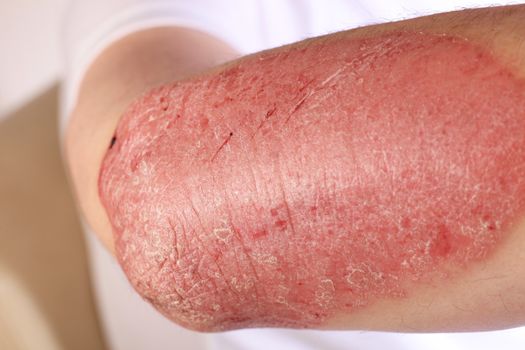 Plaque psoriasis, an immune related disease that causes inflammation of the epidermis with the formation of silvery scales or plaques on the surface, non-contagious and incurable