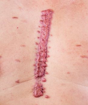 big swell cicatrix - hypertrophic scar