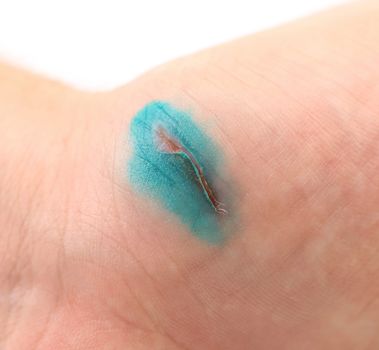 Wound on the skin worked of brilliant green. Macro.