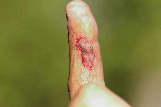 Flesh wound with blood on male finger