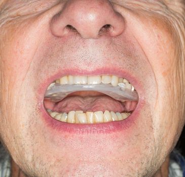 Macro close up of a plastic teethguard to stop wear due to teeth grinding at night. Often caused by tension and worry. Guard in mouth of senior male with crooked teeth