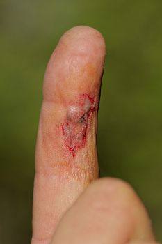 Flesh wound with blood on male finger