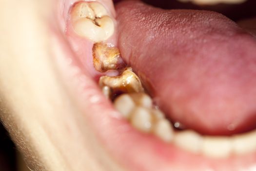 spoilt teeth in woman's open mouth