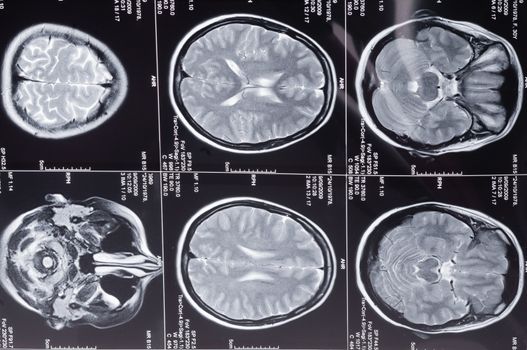 Closeup of a computer axial tomography scan (CAT scan) of a head