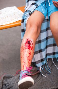 Serious injury on girl's leg