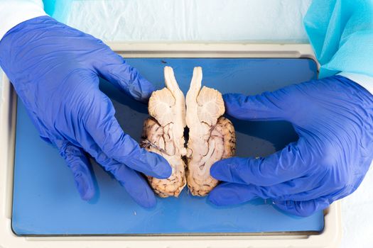 Gloved hands of a medical technologist or pathologist working in a medical laboratory holding a cross section of the brain