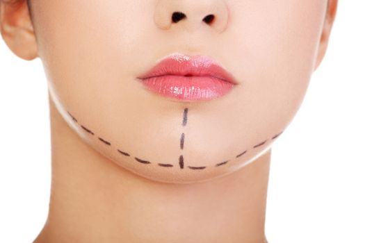 Woman marked out for cosmetic surgery. Isolated on white.