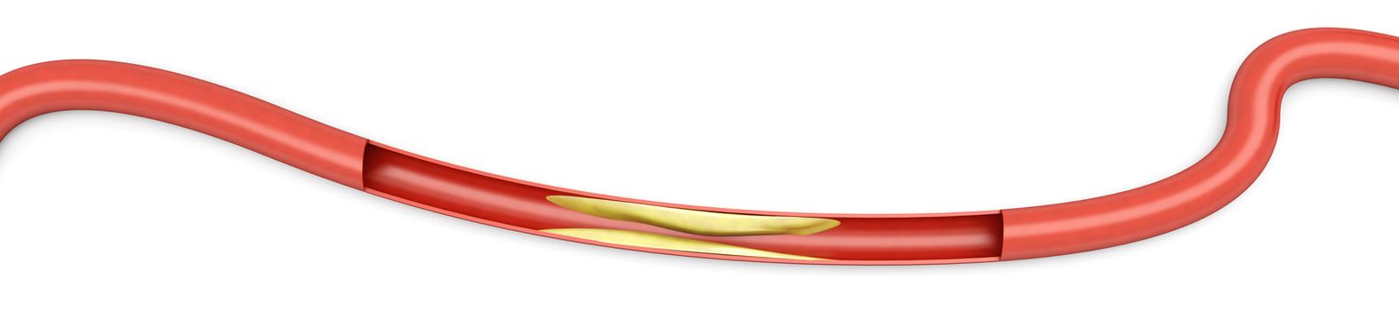 Arteriosclerosis. Plaques tightening an artery. 3D rendered Illsutration. Isolated on white.