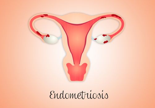 Illustration of Endometriosis