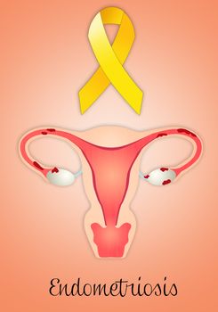 Illustration of Endometriosis