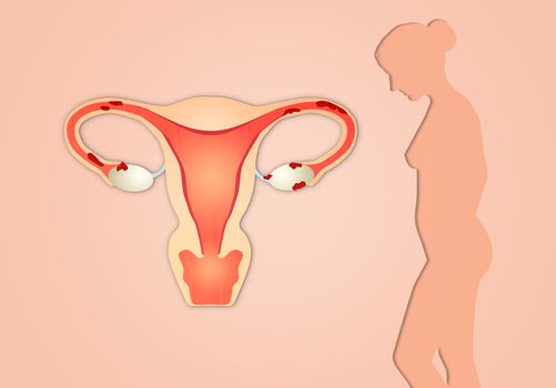 Endometriosis with woman silhouette on pink background