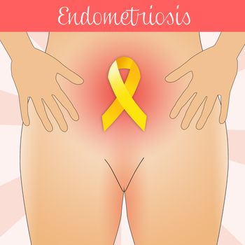illustration of Endometriosis in woman