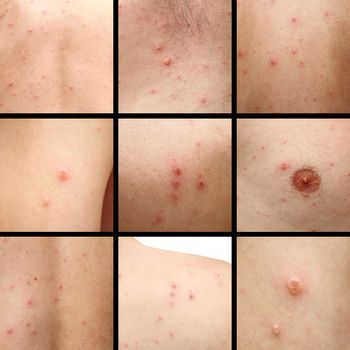 details of chicken pox blotches on human skin