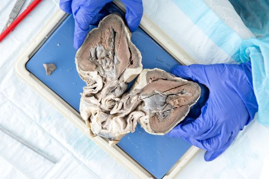 Medical student displaying a bisected heart of a sheep showing the structure of the ventricles and heart muscle during anatomy class, view from above
