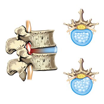 Schematic drawing of hernia of the disc, slipped disc