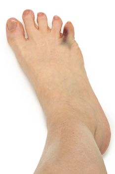 Foot with Broken Bruised Toe Over White