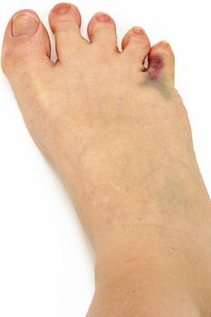 Bruised Broken Toe Over White