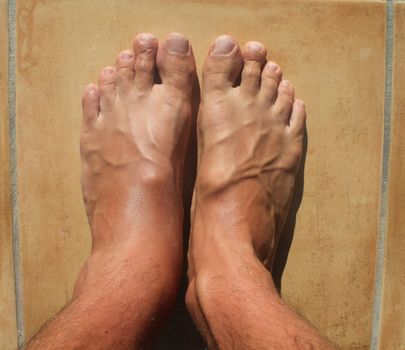 Broken ankle, mens feet