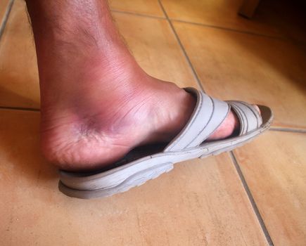broken ankle,foot man