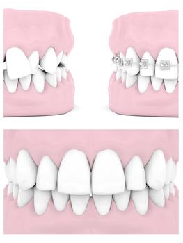 Dental braces isolated on white background