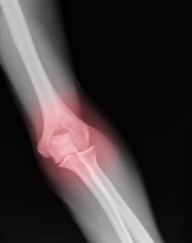 xray of an arm with elbow joint visible and red pain circle