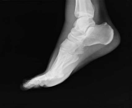 foot xray  with ankle joint visible