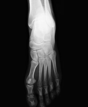 foot xray  top view