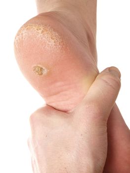 Dermatologist examining a foot for callus and dry skin, towards white