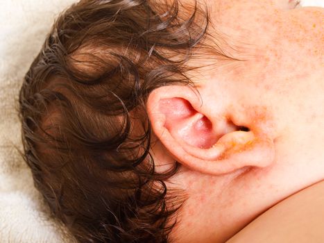 Newborn baby with lots of dark hair, red and yellow rash on ear and face