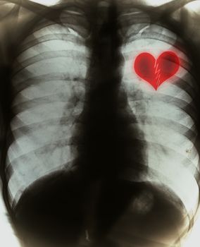 Broken heart on black x-ray film
