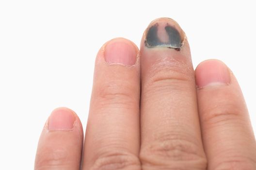 Middle Finger with Bruised Nail, Subungual Hematoma, on White Background