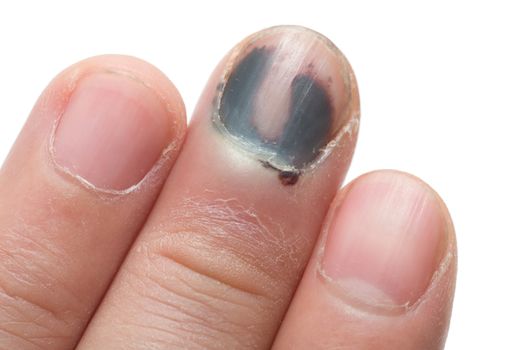 Middle Finger with Bruised Nail, Subungual Hematoma, on White Background