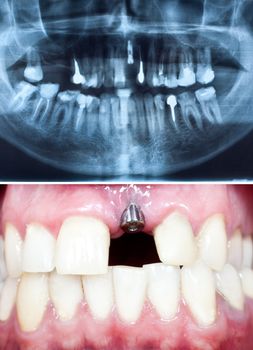 A macro shot of dental implant in the oral cavity and its Panoramic dental X-Ray 