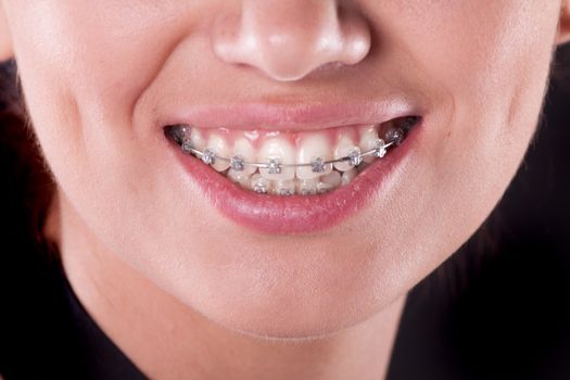 teeth with braces, close up. young woman photo.