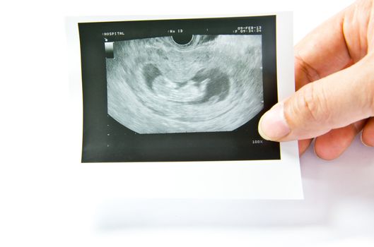 12 weeks baby ultrasound Image