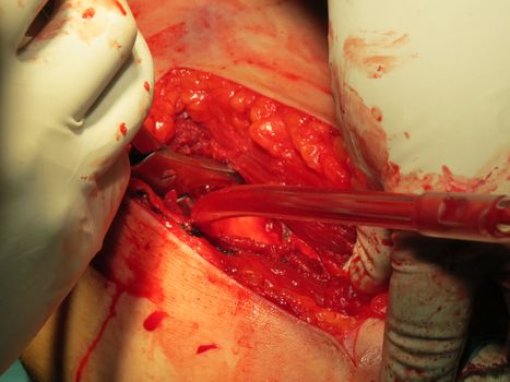 A closeup view of a surgeon holding on an open arm and draining blood out of the pipe.                               