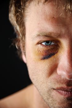 Man with an injured eye. Closeup, half face.