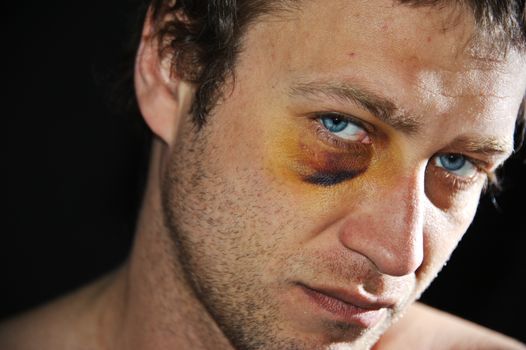 Man with an injured eye. Closeup.